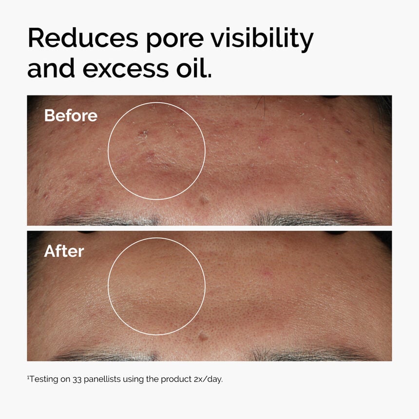 The Ordinary 1%Niacinamide 10% + Zinc 1%.  30ml
